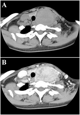 Case report: Intraoperative frozen section analysis of Thyroid paraganglioma